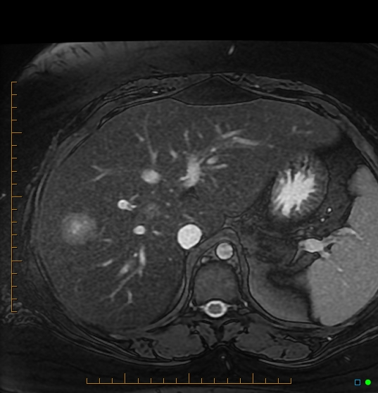 Inflammatory hepatic adenoma | Image | Radiopaedia.org