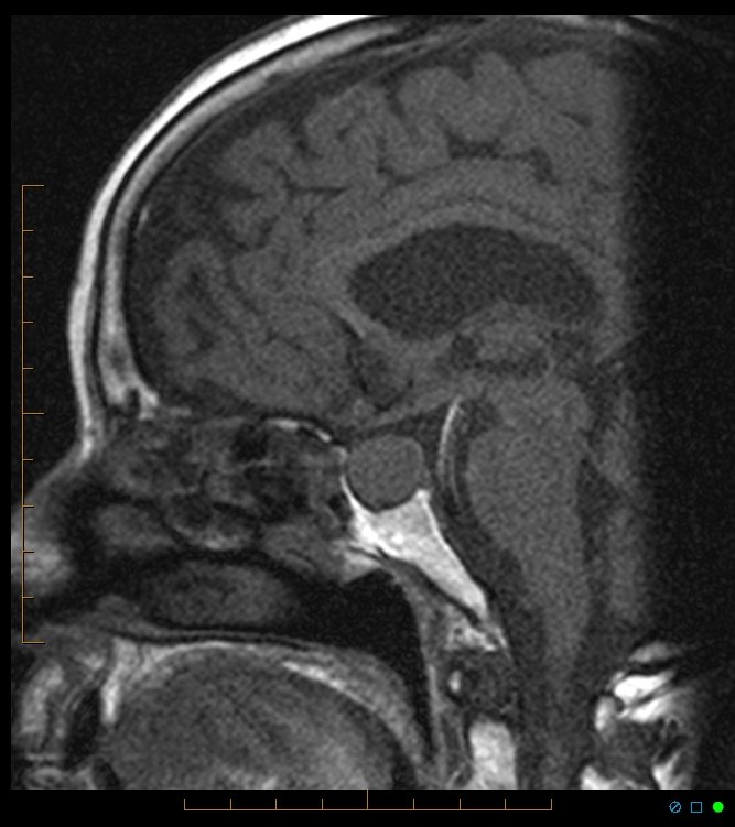 Мрт гипофиза. Аденома гипофиза кт. Аденома гипофиза мрт. Кистозная аденома гипофиза мрт. Гипофиз и турецкое седло на мрт.