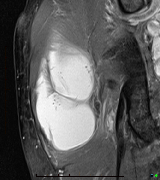 Ruptured sub gluteus maximus (trochanteric) bursa | Image | Radiopaedia.org