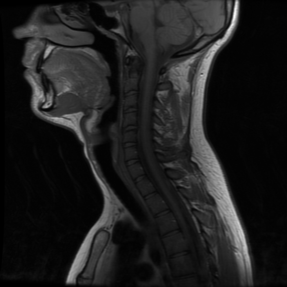 Мрт шейного позвоночника. MRI шейный отдел. Мрт шейного отдела позвоночника мягкие ткани. Мрт шейного отдела позвоночника с контрастом. Мрт шейного отдела+МРА.