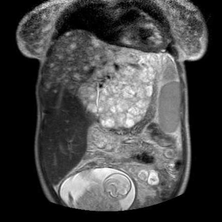 epithelioid hemangioendothelioma hepatic radiology radiopaedia