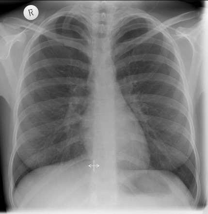 Hypoplastic first rib | Radiology Case | Radiopaedia.org