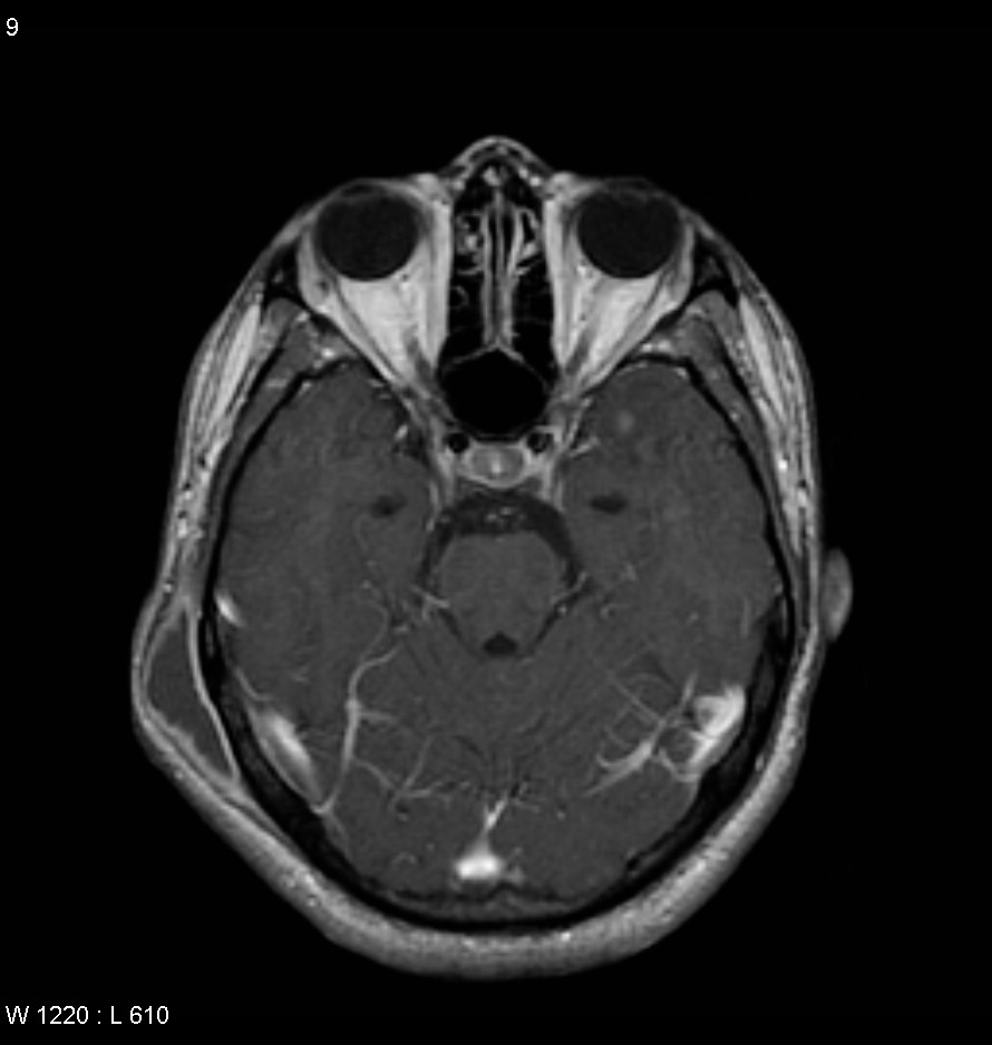 Extrapulmonary tuberculosis - multiple sites | Image | Radiopaedia.org