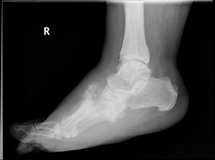 Ankle and foot radiography | Radiology Reference Article | Radiopaedia.org