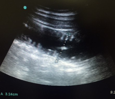 Small bowel obstruction | Radiology Reference Article | Radiopaedia.org