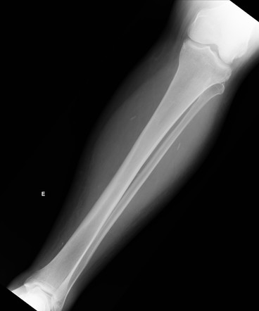 Musculoskeletal cysticercosis | Radiology Case | Radiopaedia.org