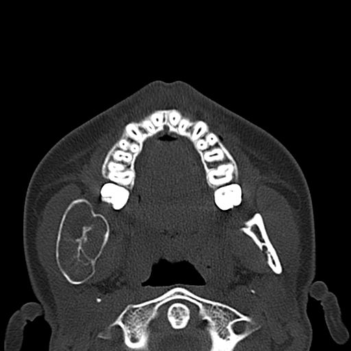 Aneurysmal Bone Cyst Of The Mandible Image