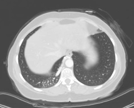 Pulmonary sequestration | Radiology Case | Radiopaedia.org