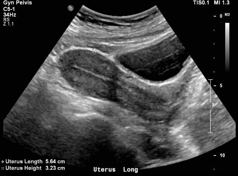 How To Read Pelvic Ultrasound