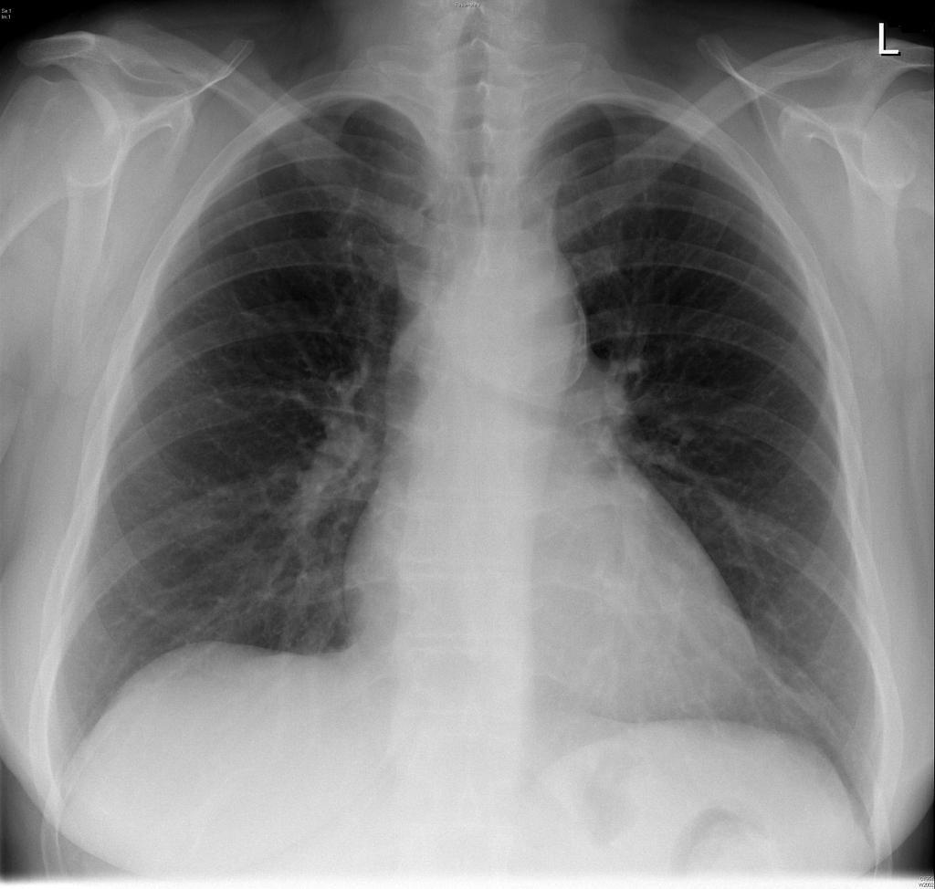 Thoracic Aortic Aneurysm Radiology Case Radiopaedia Org