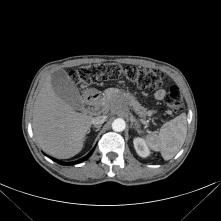 Pancreatic carcinoma | Radiology Case | Radiopaedia.org