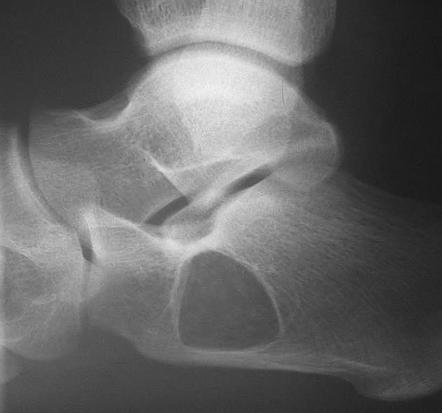 Calcaneal intraosseous lipoma | Radiology Case | Radiopaedia.org