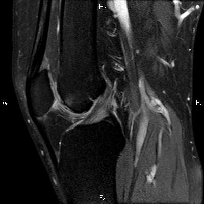 Medial patellar plica syndrome | Image | Radiopaedia.org