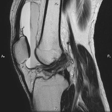 Anterior Cruciate Ligament (acl) (tibial Eminence) Avulsion Fracture 