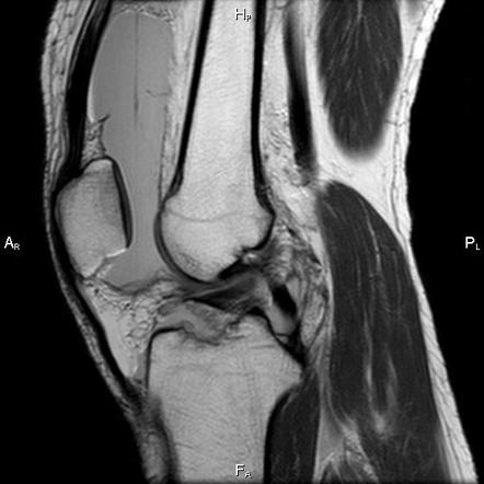 Anterior cruciate ligament (ACL) (tibial eminence) avulsion fracture ...