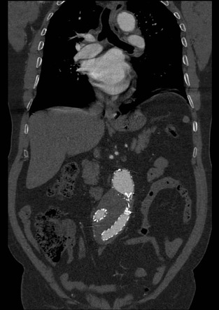 Endoleak - type Ib | Radiology Case | Radiopaedia.org