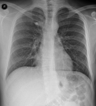 Azygos fissure | Radiology Case | Radiopaedia.org