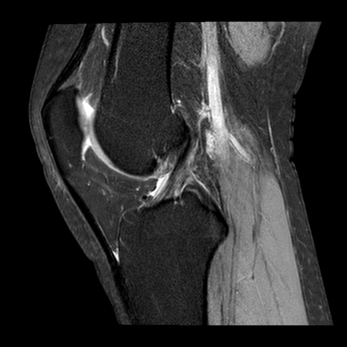 A Arthroscopic View Of The Anterior Cruciate Ligament - vrogue.co