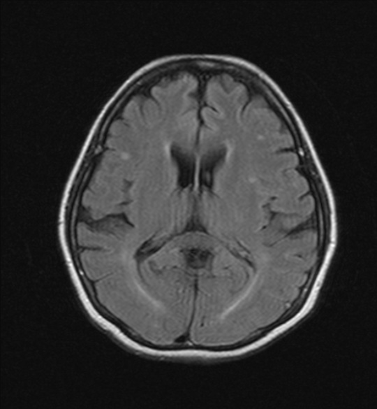 Frontotemporal dementia: right temporal variant | Image | Radiopaedia.org