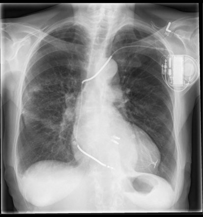 Parachute device | Radiology Reference Article | Radiopaedia.org