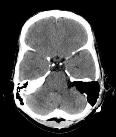 Acoustic Schwannoma (translabyrinthine Resection) 