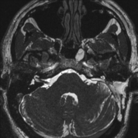 Acoustic schwannoma (translabyrinthine resection) | Image | Radiopaedia.org