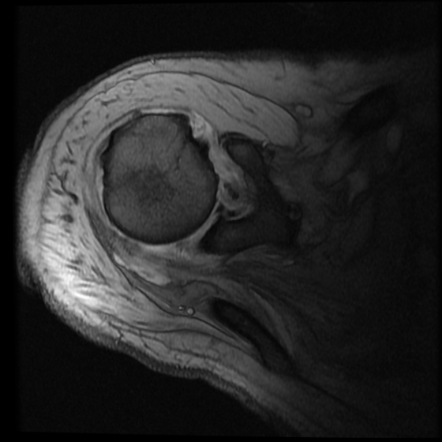 Viewing playlist: Adhesive capsulitis | Radiopaedia.org