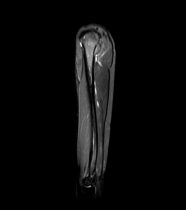 Normal MRI of the arm | Image | Radiopaedia.org