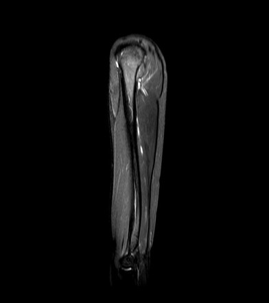 Normal MRI of the arm | Image | Radiopaedia.org