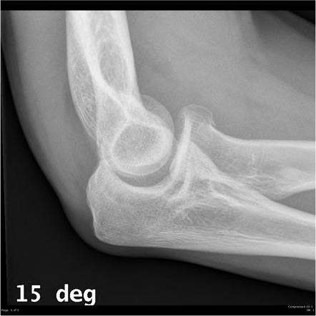 non displaced radial head fracture