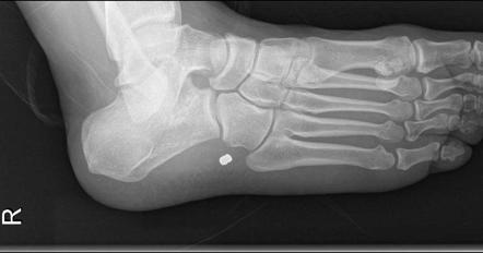 Foreign body in foot | Radiology Case | Radiopaedia.org