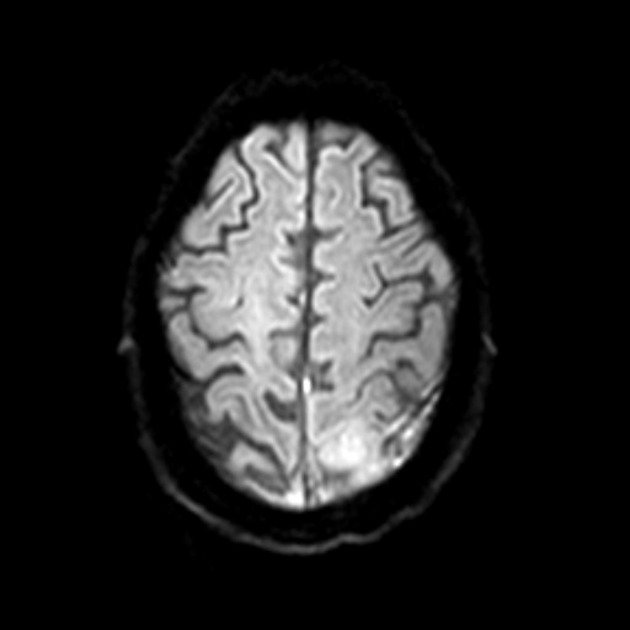 Pachymeningitis | Image | Radiopaedia.org