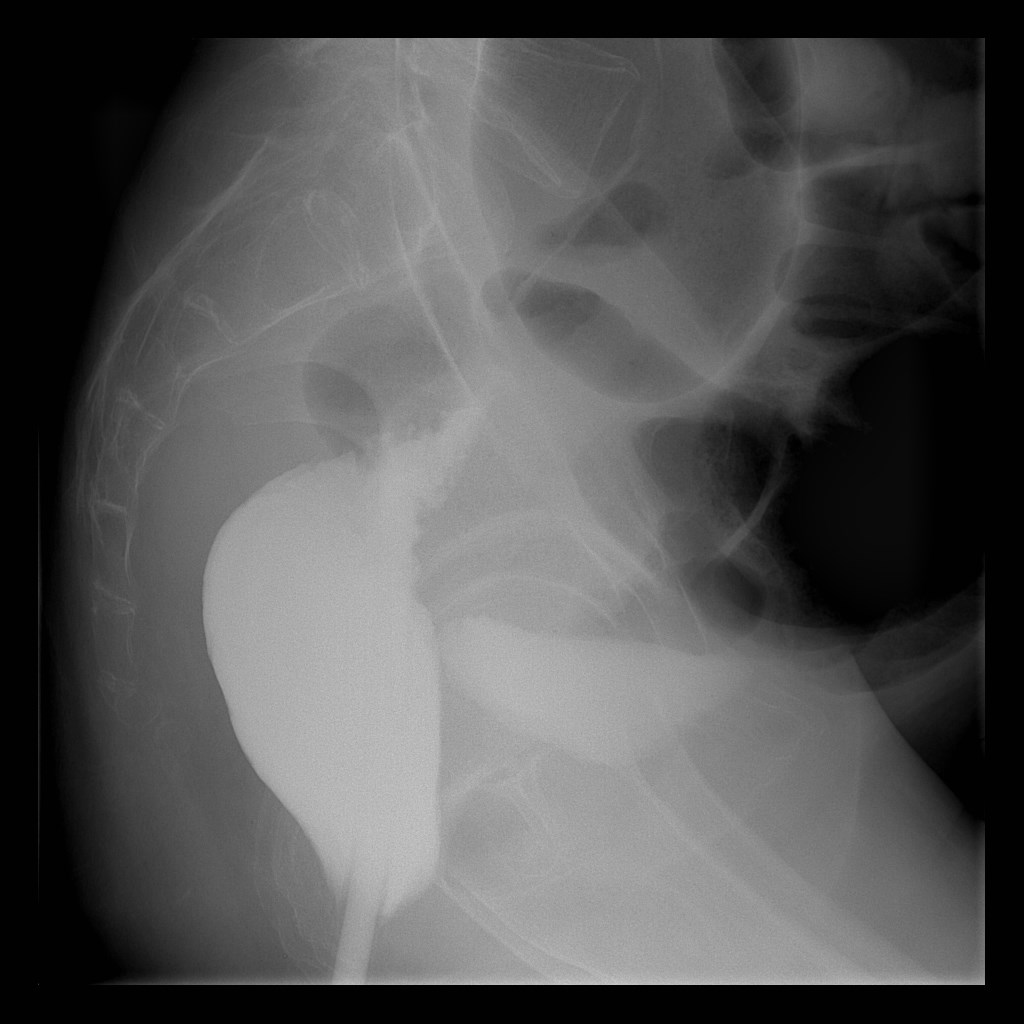 Sigmoid volvulus with therapeutic rectal enema | Image | Radiopaedia.org