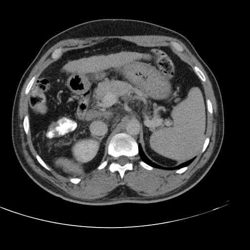 Horseshoe kidney | Image | Radiopaedia.org