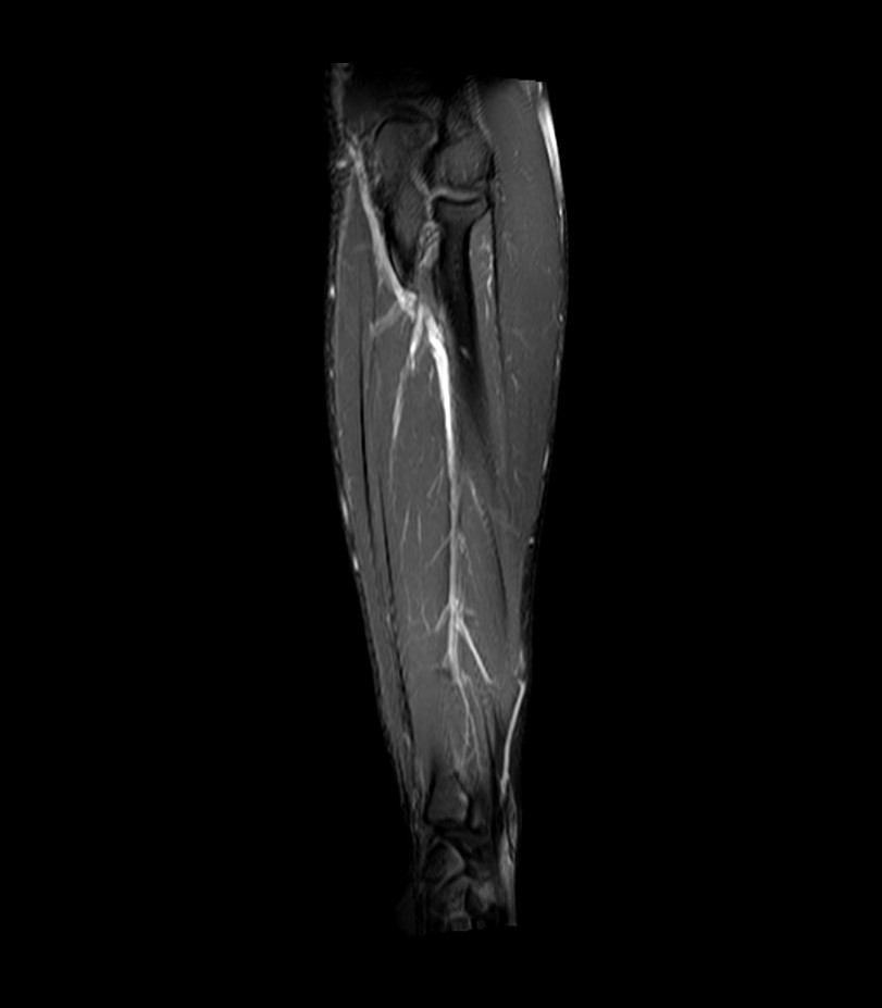 Normal MRI of the forearm | Image | Radiopaedia.org