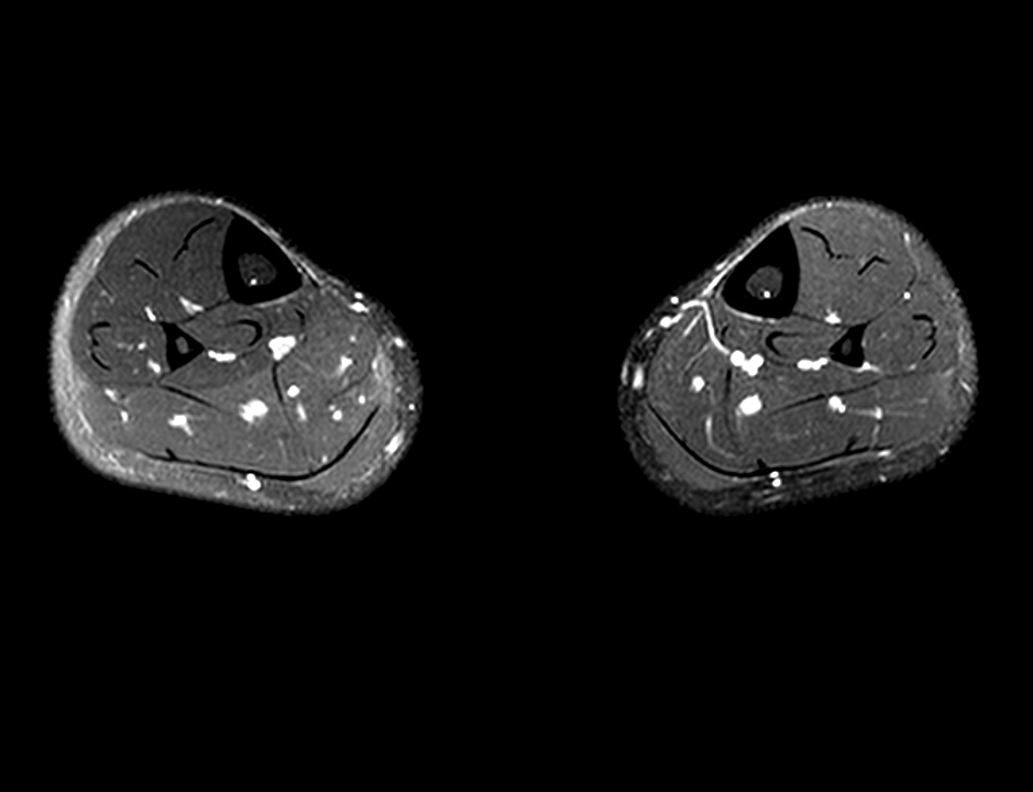 Chronic exertional compartment syndrome | Image | Radiopaedia.org