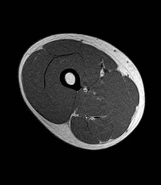 Normal Mri Of The Thigh Radiology Case Radiopaedia Org