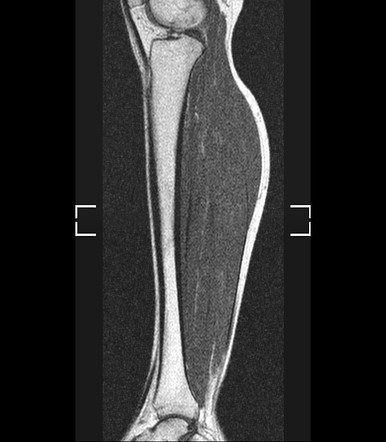 Normal MRI of the leg | Image | Radiopaedia.org