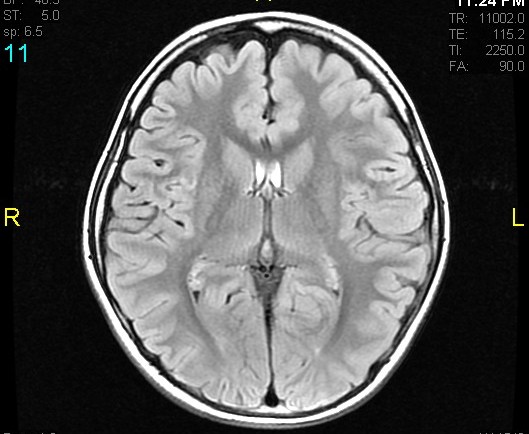 Developmental Venous Anomaly Image