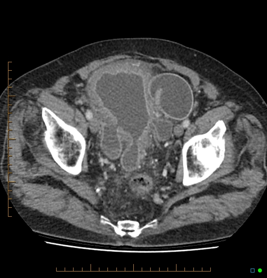 Gross Bladder Diverticula Secondary To Outlet Obstruction | Image ...