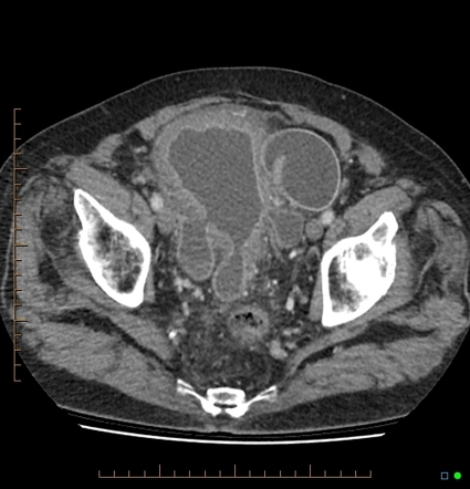 Gross bladder diverticula secondary to outlet obstruction | Image ...