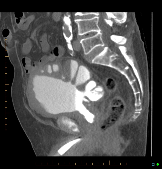 Gross bladder diverticula secondary to outlet obstruction | Image ...