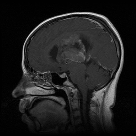 Central neurocytoma | Image | Radiopaedia.org