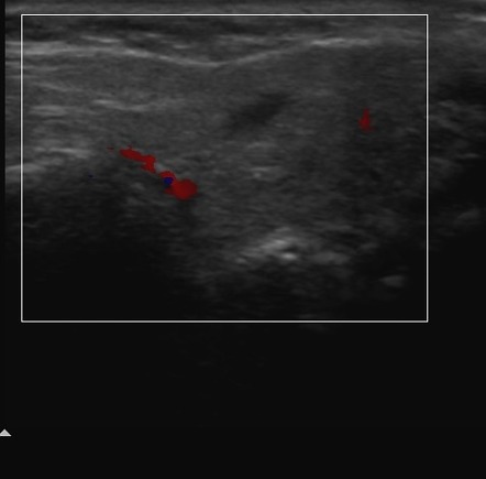 Acute viral parotitis | Image | Radiopaedia.org