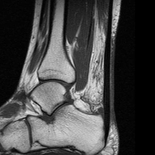 Achilles paratenonitis | Image | Radiopaedia.org