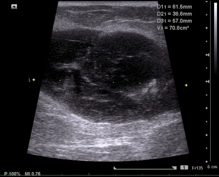 Gluteal Hematoma