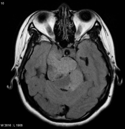 Neurofibromatosis type 2 - cranial and spinal involvement | Image ...