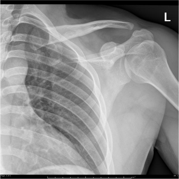 AC Joint Separation - Clinical Guide Wiki