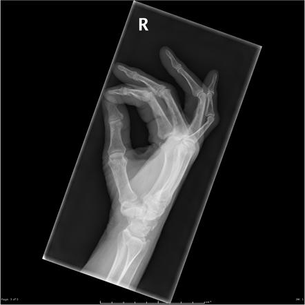 Boutonnière deformity | Radiology Reference Article | Radiopaedia.org