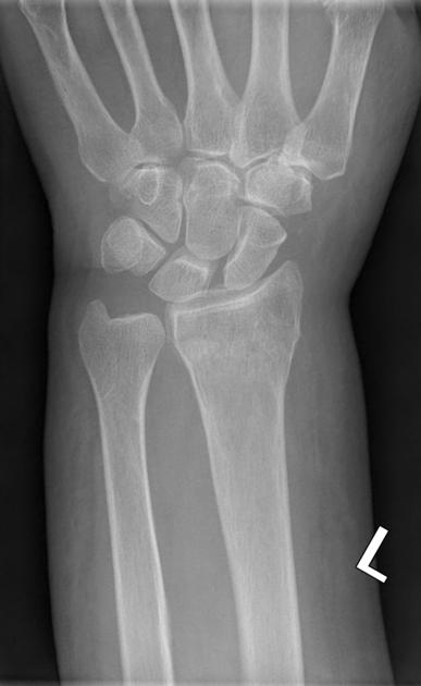 Colles' fracture of the wrist, illustration - Stock Image - C046/2994 -  Science Photo Library